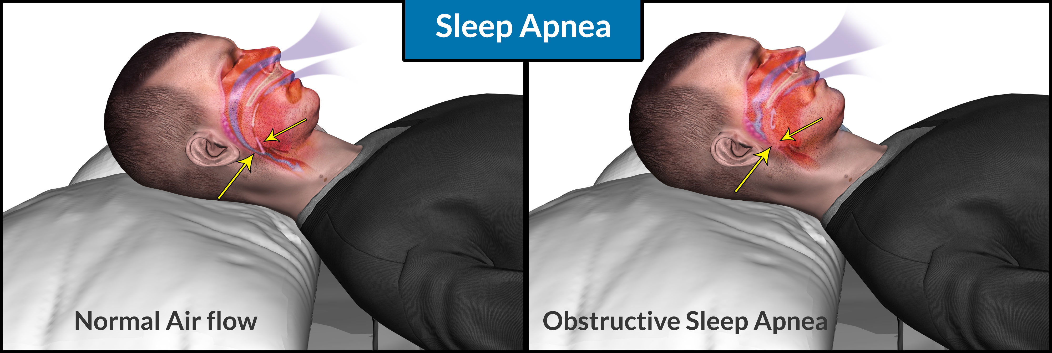 Obstructive Sleep Apnoea Treatment In Pune PCMC Mild Sleep Apnea 